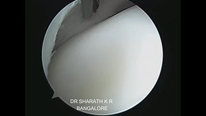 Why Does Discoid Lateral Meniscus Snaps/Clicks on Each Flexion and Extension of Knee - How Is It Treated?