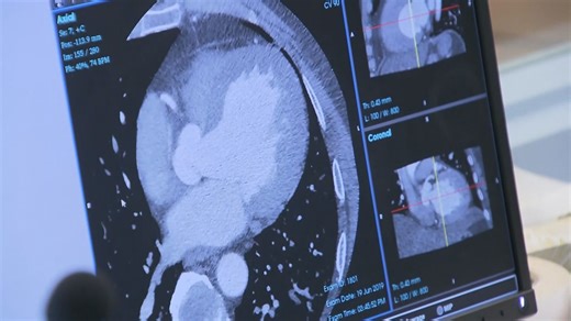 Cancer death rates in Canada declining but these types are expected to rise