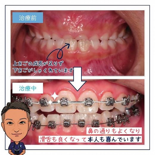 下顎前突の治療例をご紹介｜ご予約は右上の３点から説明へ！発音・滑舌も改善して笑顔に😊#下顎前突 #発音改善 #小児矯正