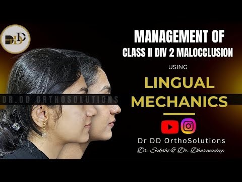 Management of Class II Division 2 Malocclusion using Lingual Orthodontics.