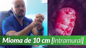 Extracción de un mioma [10 cm. intramural] | Creafam
