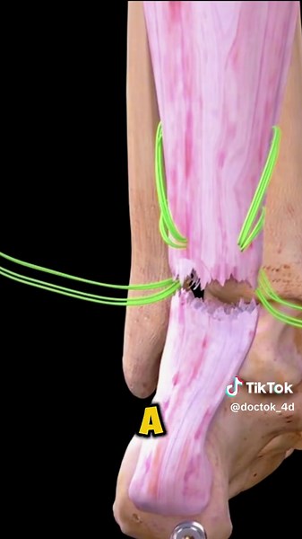 Reparación del Tendón de Aquiles: Animación Médica 3D