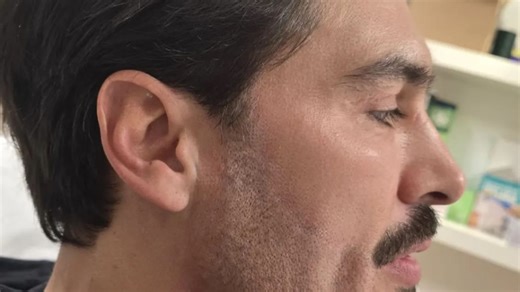 Towie’s Mario Falcone reveals he’s had whole beard tattoo lasered off