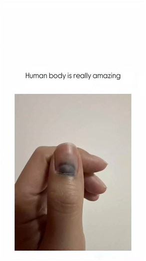@pixel.poe on Instagram: "The post features a time-lapse video of a severely bruised fingernail detaching and fully regrowing over months, illustrating the body’s natural regeneration process after trauma like a subungual hematoma. Fingernails regenerate from the nail matrix at about 3-4 mm per month, with full recovery typically taking 4-6 months, as supported by dermatological studies in the Journal of Investigative Dermatology. Replies highlight practical tips like relieving pressure by punct