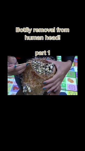 Botfly Larvae Removal from Human Head - Part 1