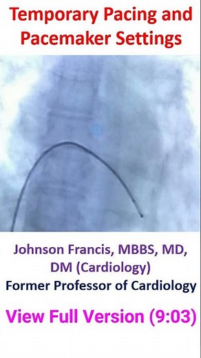 Temporary Pacing and Pacemaker Settings