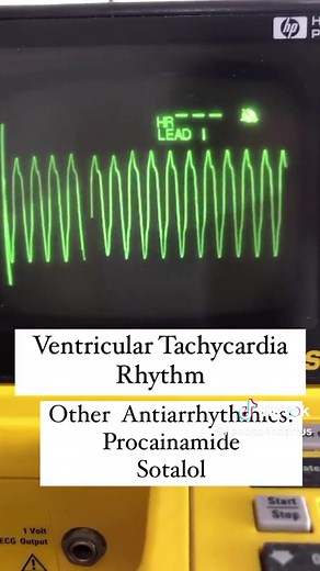 Book AHA BLS, ACLS, PALS, HeartSaver with us. Link in BIO. This is a Ventricular Tachycardia (regular rhythm with widened QRS). First we need to know if it is a VT with a pulse or a pulseless VT; if the patient does not have a pulse, we are facing a cardiac arrest, and resuscitation maneuvers must be initiated and defibrillation (shock) carried out quickly. If the patient has a pulse (VT with a pulse), we need to know if the patient is unstable or stable. If unstable (acute change in mental stat