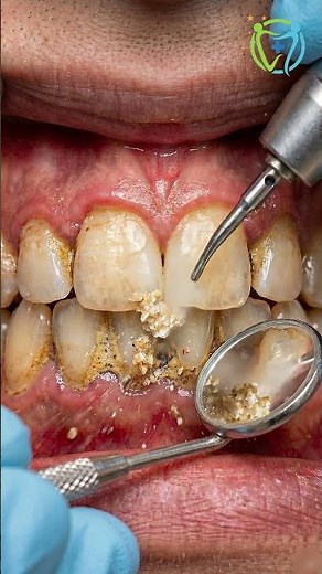 Plaque and Tartar Removed – Hard buildup cleaning from teeth