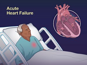 Among patients presenting to the ED with acute heart failure, the risk of adverse events is often unclear. Whether the use of a clinical decision-making tool might improve outcomes is uncertain. New research findings are summarized in a short video. https://nej.md/3WJ2G6e | The New England Journal of Medicine