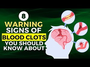8 Warning Signs of Blood Clots You Should Know About
