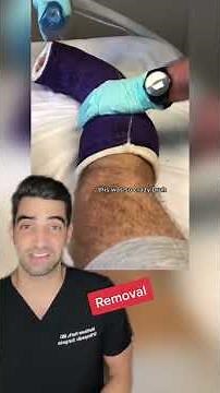 Itchy Cast Removal from a Broken Ankle