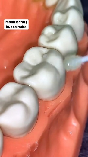 Buccal tube placement #Dentistry #LearningTips #BitesnBraces #smile #medical #People #dentista #Tooth #Implant #Dental #dentist | Bites & Braces Dental
