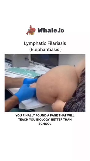 BIOLOGY | HEALTH | MEDICAL | Lymphatic filariasis, commonly called elephantiasis, is a disfiguring and disabling parasitic disease transmitted by mosquitoes that... | Instagram