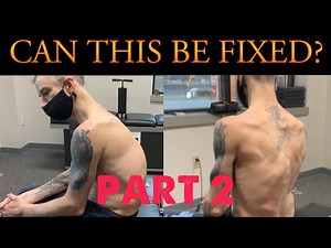 Severe Scoliosis & Kyphosis ~ Advanced Technique For A Spine In Critical Condition. Chiropractic 47.