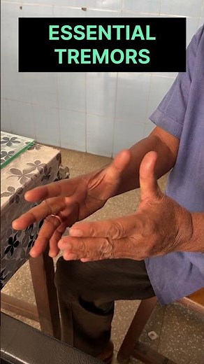 Essential tremors |Action Tremors #viralvideo #neurology #trending #tremor