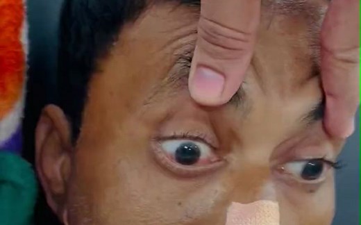 头眼反射消失 Doll’s Eye Reflex