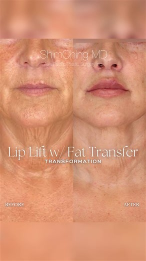 Dr. Shim Ching | Double Board Certified Plastic Surgeon on Instagram: "Subtle enhancements, stunning results ✨ Our patient’s Lip Lift with Fat Transfer has beautifully enhanced her lips, creating a fuller, natural look while maintaining perfect balance with her features. This procedure was part of her Full Face Rejuvenation, and you can also see the transformative impact of her Deep Plane Neck Lift—completely redefining her neck and neck contours. Sometimes, it’s the fine details that make all t