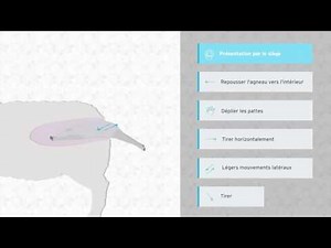 Dystocie – Presentation en siège complet