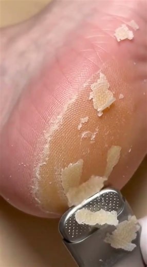 Extremely Satisfying Foot Callus Removal | 100% Clean Results