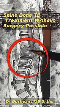Spine TB Treatment With Medicine ✅ #PottsSpineTreatment #tuberkulosis #BoneTBRecovery