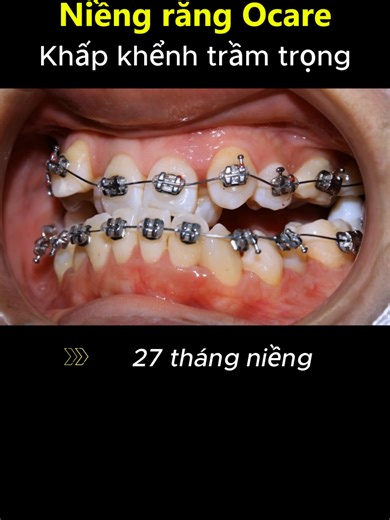 Niềng răng khấp khểnh và cắn ngược, hành trình 27 tháng tại Ocare #niengrang #orthodontist #braces #nhakhoa #dental
