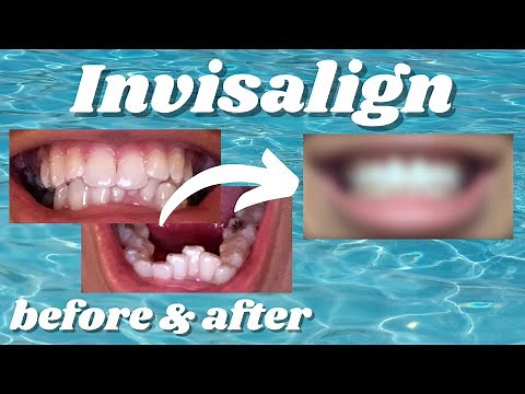 My Incredible Invisalign Transformation