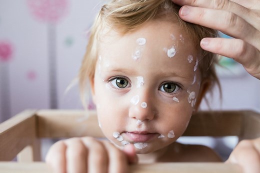 Chickenpox in children: early signs, symptoms and treatment - Netmums