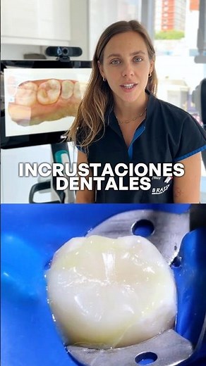 INCRUSTACIONES DENTALES #odontologiabravo #alineadoresinvisibles #incrustaciones #dentista