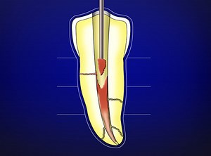 Vertical Condensation Technique - Step-by-Step Graphic Sequence