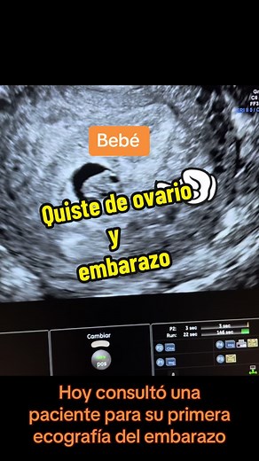Quiste de ovario y embarazo: Consulta de ecografía y diagnóstico