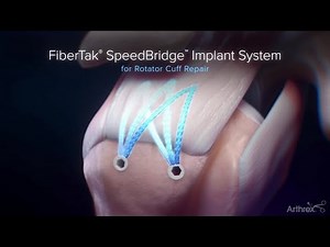 FiberTak® SpeedBridge™ Implant System Features and Benefits