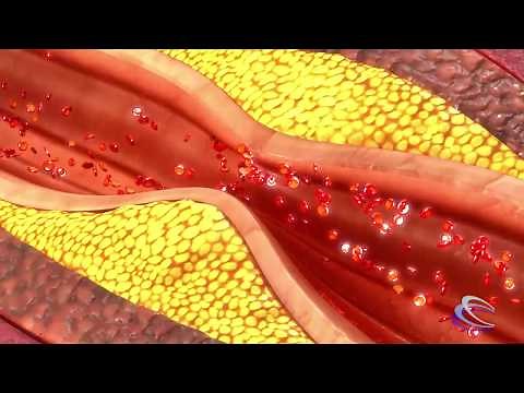 Carotid Endarterectomy Neurosurgery at Carilion Clinic
