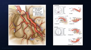#409: Mini-Pterional Craniotomy for Clipping of an M2 Middle Cerebral Artery Aneurysm - All Videos - Seven Series Collection