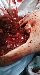 Visual demonstration of the intensity of arterial bleeding