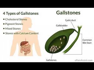 Drinking apple cider to flush out gall bladder stones [ENG SUB]