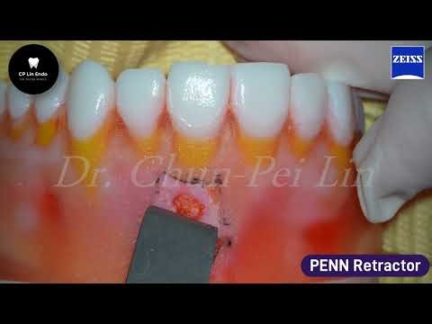 Microscopic apical surgery- demo with model 顯微根尖手術-模型示範