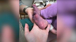 Infant survives rare life-threatening COVID-related illness