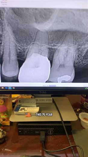 RCT of this calcified tooth through a crown. #rct #rootcanal #rootcanaltherapy #rootcanaltreatment #dentistry #dentalschool #dentists | Advanced Micro-Endodontics