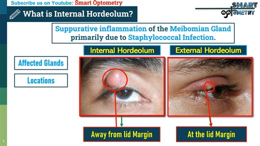 What is Internal Hordeolum & How to Differentiate it from External Hordeolum-麦粒肿