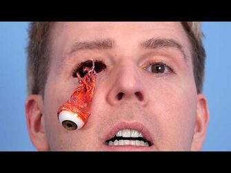 BASEBALL KNOCKS EYEBALL OUT!