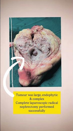 Renal Tumour Removed with Laparoscopic Radical Nephrectomy | Life-Saving Precision | Dr Nitin Negi