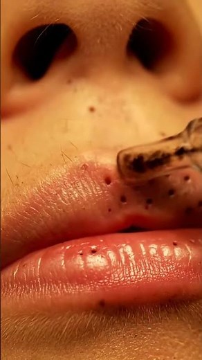 Upper Lip Blackhead Vacuum ASMR (Extreme Detail) #satisfying #blackheadcaique #skincare #asmr