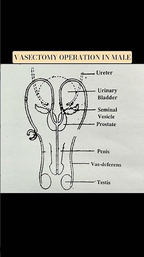 VASECTOMY OPERATION IN MALE!!#vasectomy #vasectomia #vasectomyreversal #operationsindoor