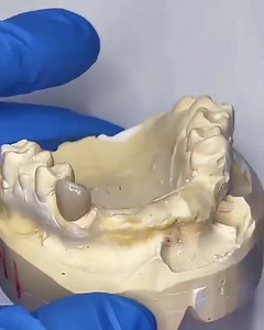 2.9K views · 154 reactions | Flexible (valplast) Denture. Credit @prodirect_dental_lab #Dentistry #LearningTips | Bites & Braces Dental | Facebook