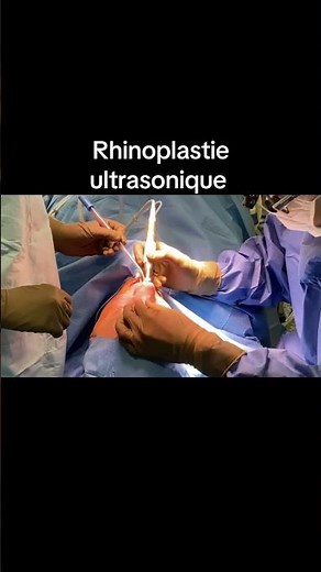 Rhinoplastie ultrasonique par voie fermée. Closed ultrasonic rhinoplasty