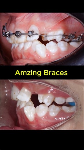 Amazing braces. Super crowded teeth transformation #braces #orthodontist #dentist #teeth