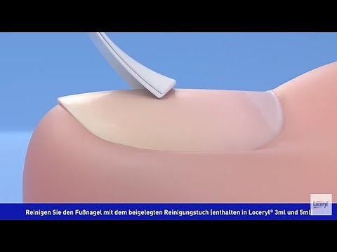 Loceryl® Nagellack gegen Nagelpilz Anwendung