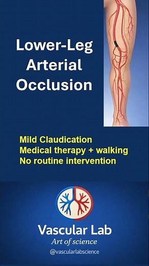 Blocked Artery — But No Surgery Needed?