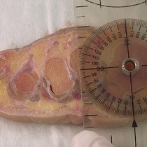 Video: An Anatomical Study of Nerves at Risk During Minimally Invasive Hallux Valgus Surgery