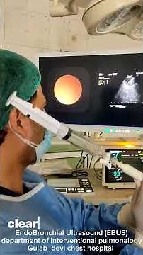 Endobronchial ultrasound guided Hilar lymph node biopsy procedure and biopsy.#ebus